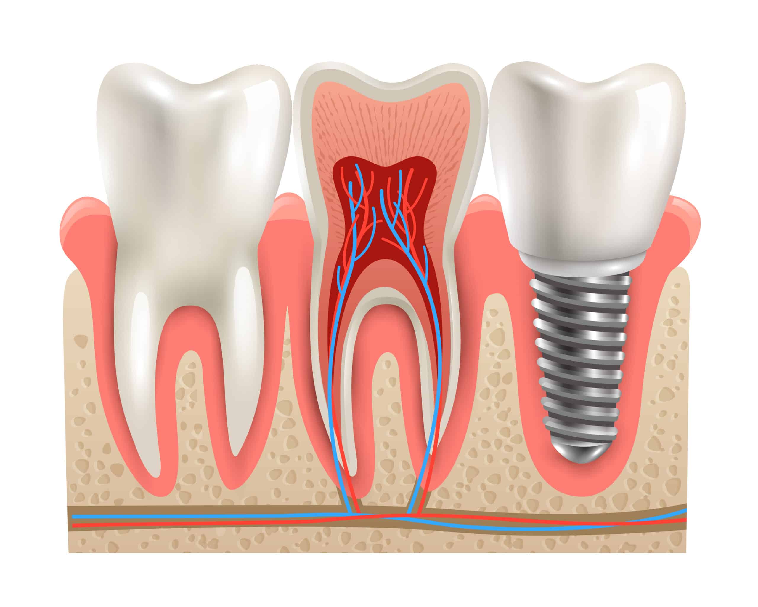 Dental Implant in Fenton, MI