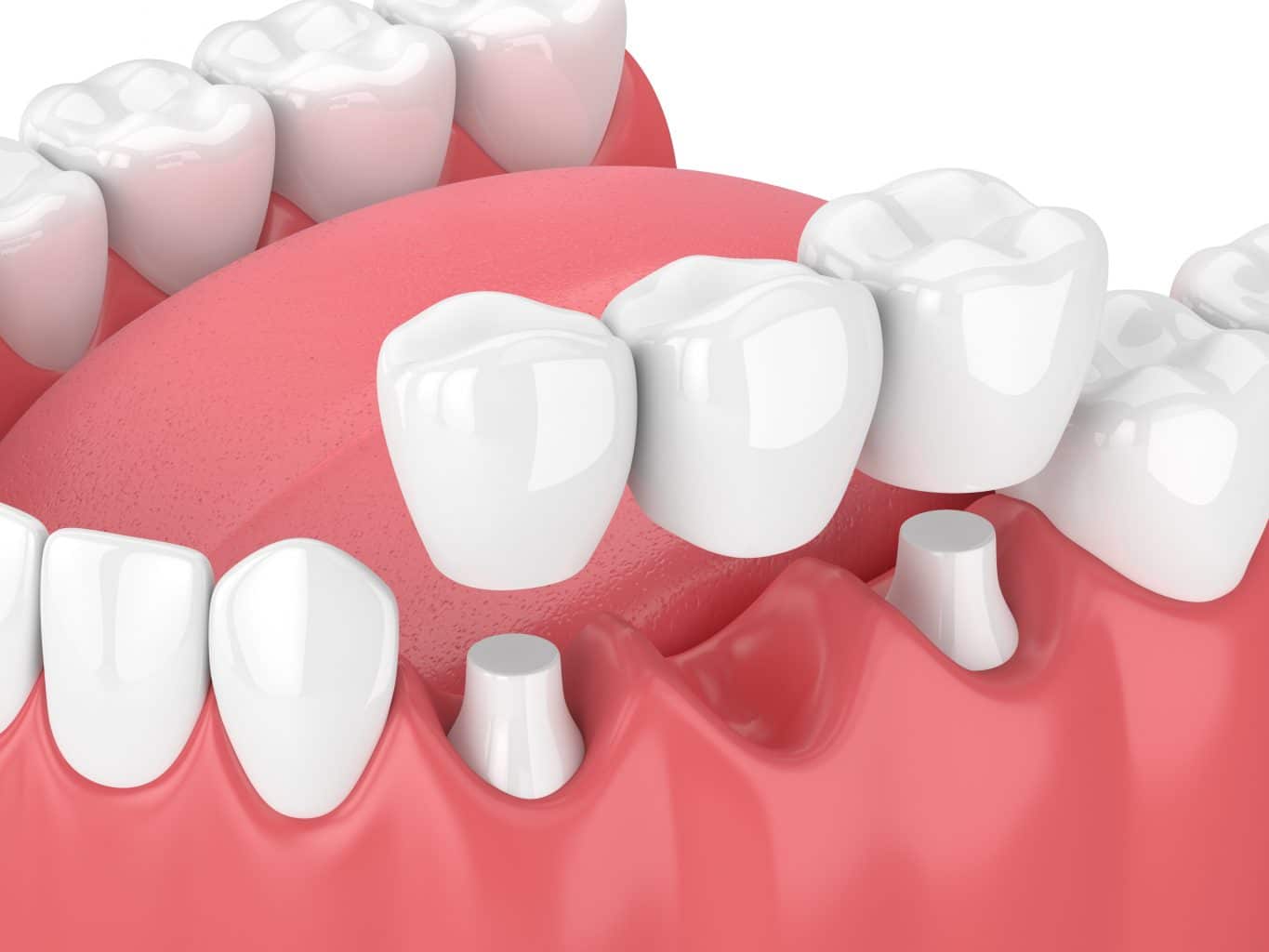 Dental Bridges In Fenton, MI