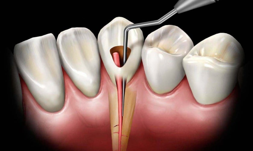 Featured image for “Does The Tooth Pain Increase Days After Root Canal Treatment?”