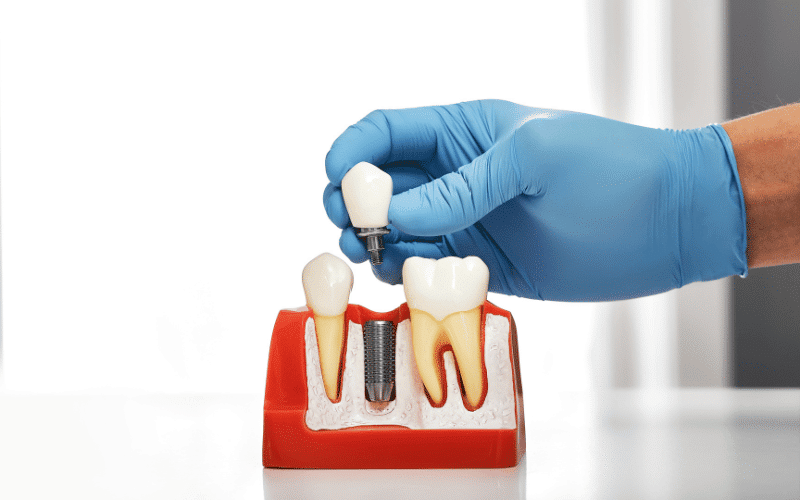 Dental Implants