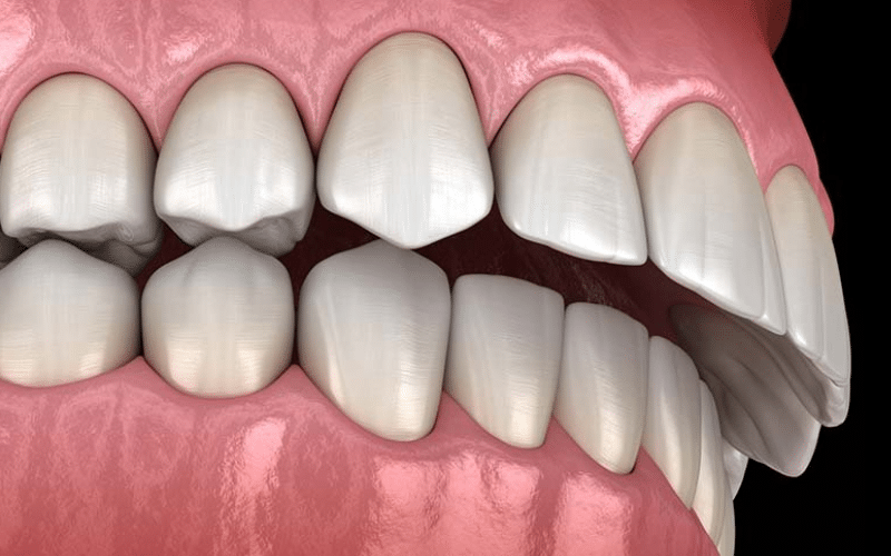 Effective Solutions To Fix Overbite