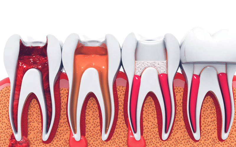 Signs you need a root canal
